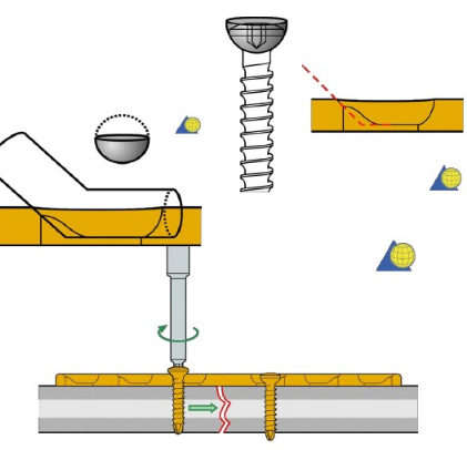 生物钉是什么材料骨折常用内固定材料&选择原则，超详细！_https://www.jmylbn.com_新闻资讯_第23张