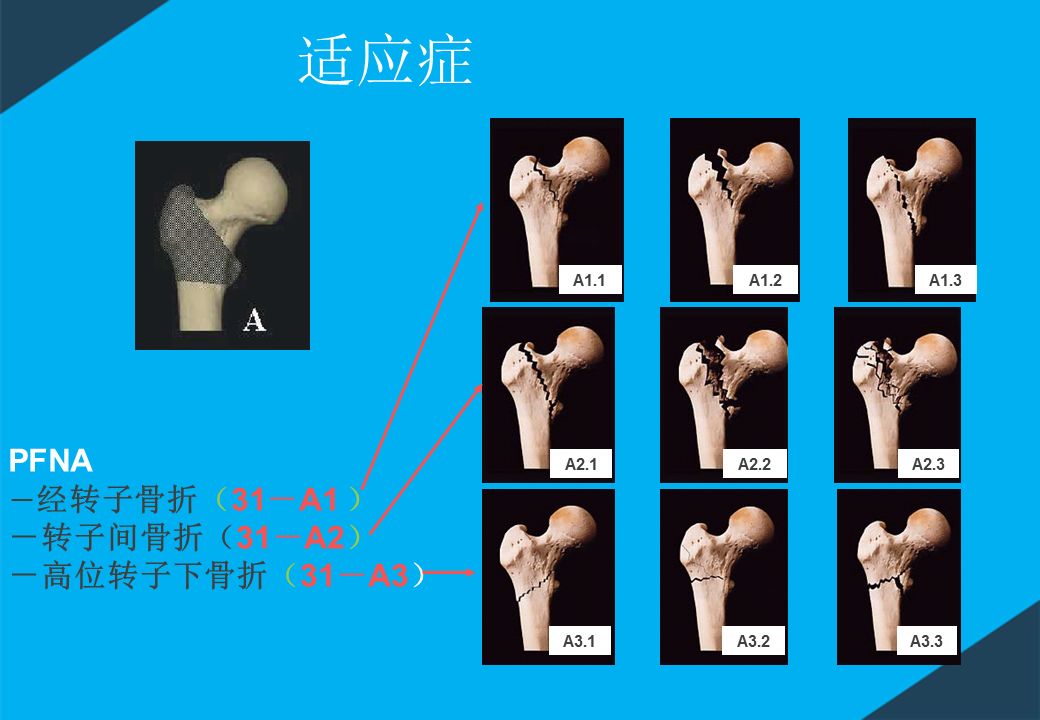 股骨粗隆间骨折PFNA内固定的4大关键总结，实用！