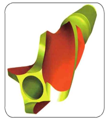 股骨粗隆间骨折PFNA内固定的4大关键总结，实用！