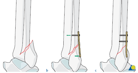 生物钉是什么材料骨折常用内固定材料&选择原则，超详细！_https://www.jmylbn.com_新闻资讯_第21张