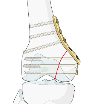 生物钉是什么材料骨折常用内固定材料&选择原则，超详细！_https://www.jmylbn.com_新闻资讯_第19张