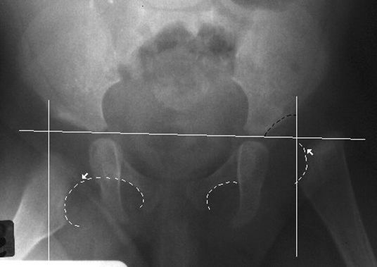 39种常见骨科疾病的X线表现，看你认识几种？