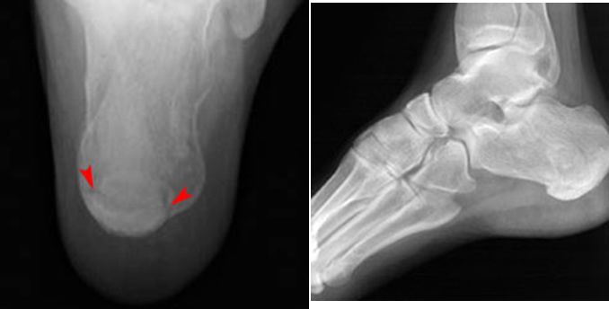 疼痛科怎么理疗疼痛科医生、康复理疗科医生、针刀针灸医生应掌握的常见骨科疾病X光片_https://www.jmylbn.com_新闻资讯_第44张