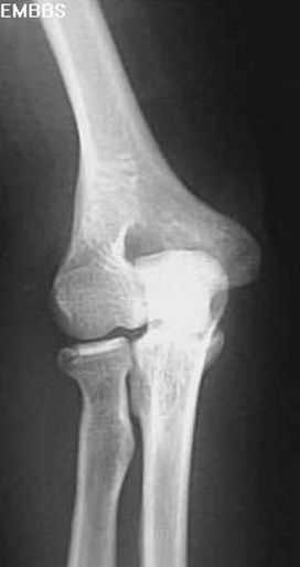 疼痛科怎么理疗疼痛科医生、康复理疗科医生、针刀针灸医生应掌握的常见骨科疾病X光片_https://www.jmylbn.com_新闻资讯_第16张