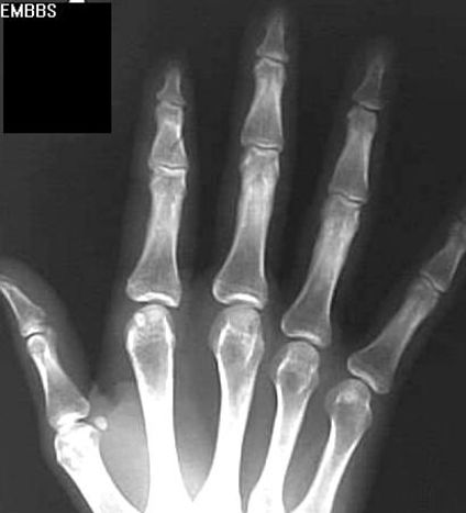 39种常见骨科疾病的X线表现，看你认识几种？