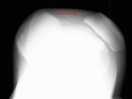 疼痛科怎么理疗疼痛科医生、康复理疗科医生、针刀针灸医生应掌握的常见骨科疾病X光片_https://www.jmylbn.com_新闻资讯_第34张