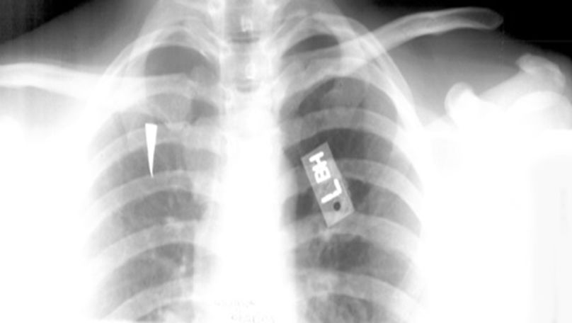 39种常见骨科疾病的X线表现，看你认识几种？