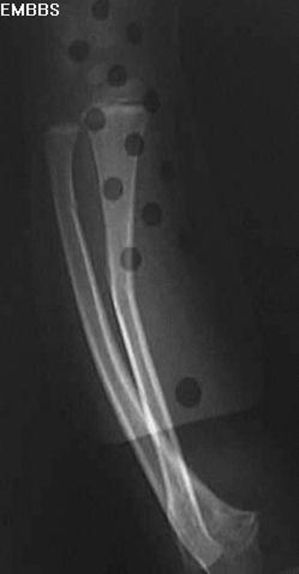 疼痛科怎么理疗疼痛科医生、康复理疗科医生、针刀针灸医生应掌握的常见骨科疾病X光片_https://www.jmylbn.com_新闻资讯_第18张