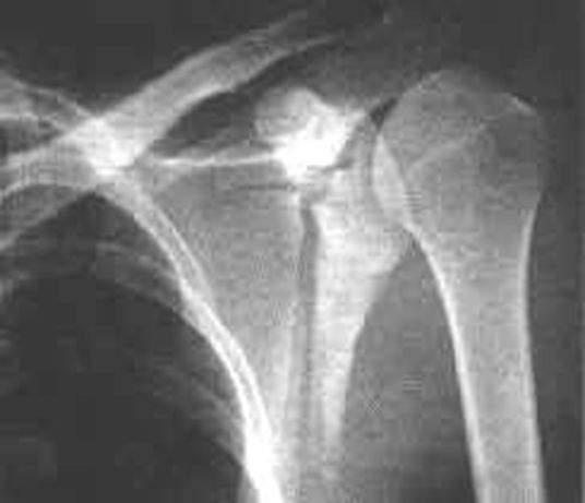 39种常见骨科疾病的X线表现，看你认识几种？