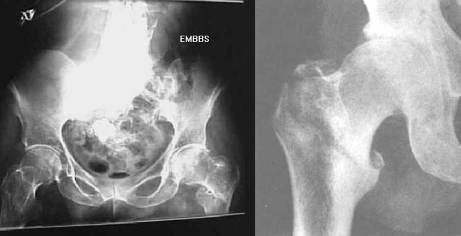 疼痛科怎么理疗疼痛科医生、康复理疗科医生、针刀针灸医生应掌握的常见骨科疾病X光片_https://www.jmylbn.com_新闻资讯_第31张