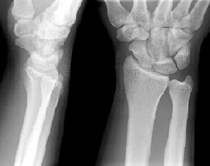 39种常见骨科疾病的X线表现，看你认识几种？