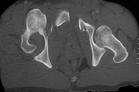 疼痛科怎么理疗疼痛科医生、康复理疗科医生、针刀针灸医生应掌握的常见骨科疾病X光片_https://www.jmylbn.com_新闻资讯_第50张