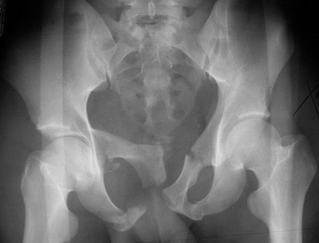 39种常见骨科疾病的X线表现，看你认识几种？