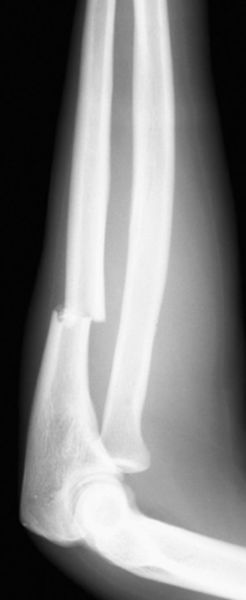 39种常见骨科疾病的X线表现，看你认识几种？