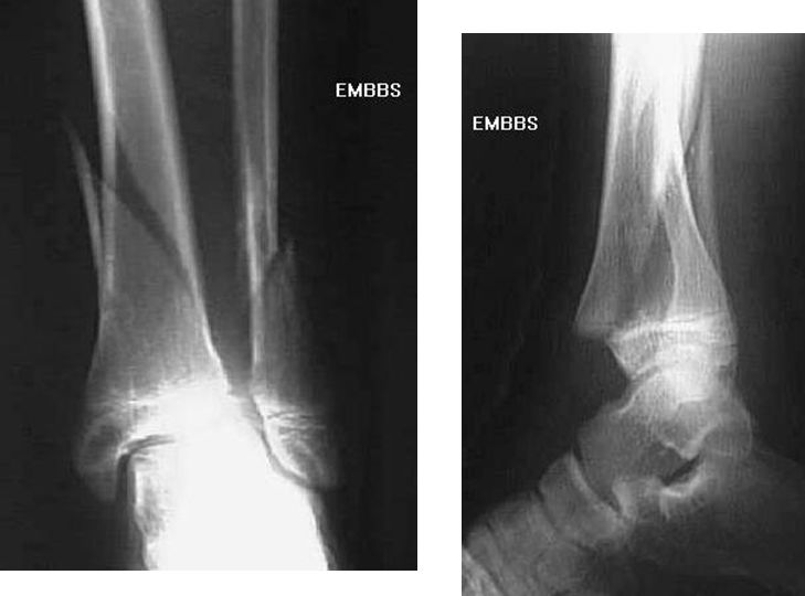 疼痛科怎么理疗疼痛科医生、康复理疗科医生、针刀针灸医生应掌握的常见骨科疾病X光片_https://www.jmylbn.com_新闻资讯_第40张