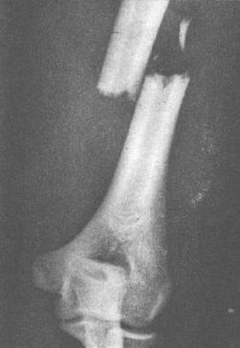 39种常见骨科疾病的X线表现，看你认识几种？