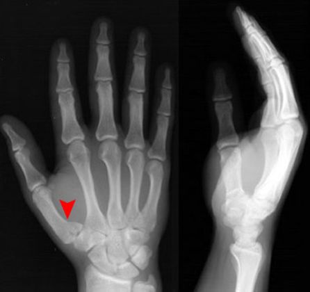 疼痛科怎么理疗疼痛科医生、康复理疗科医生、针刀针灸医生应掌握的常见骨科疾病X光片_https://www.jmylbn.com_新闻资讯_第28张