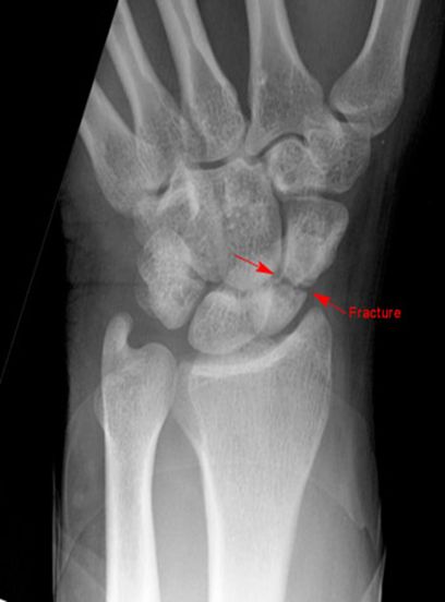 疼痛科怎么理疗疼痛科医生、康复理疗科医生、针刀针灸医生应掌握的常见骨科疾病X光片_https://www.jmylbn.com_新闻资讯_第26张