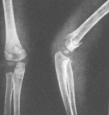 39种常见骨科疾病的X线表现，看你认识几种？