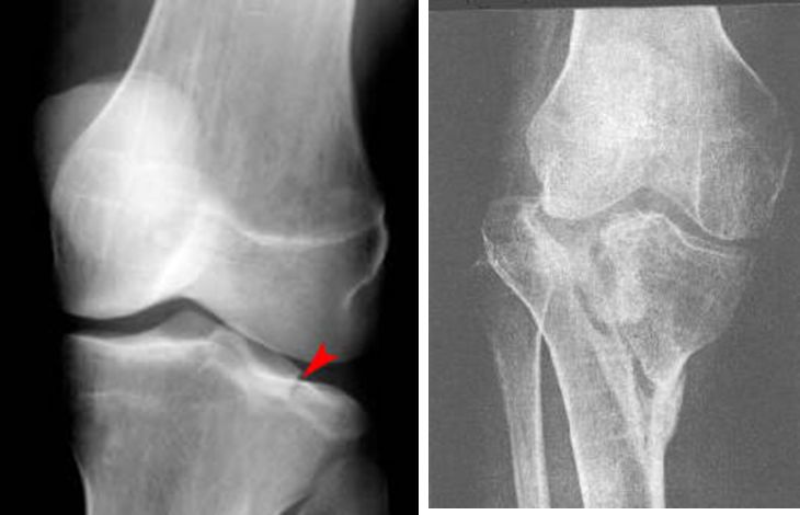 39种常见骨科疾病的X线表现，看你认识几种？