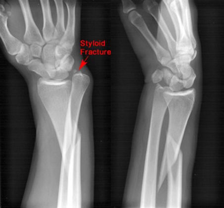 疼痛科怎么理疗疼痛科医生、康复理疗科医生、针刀针灸医生应掌握的常见骨科疾病X光片_https://www.jmylbn.com_新闻资讯_第20张