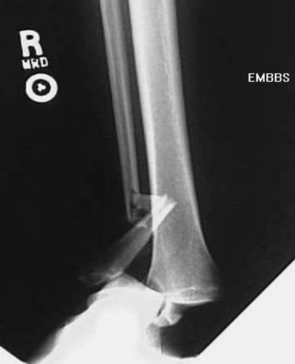 疼痛科怎么理疗疼痛科医生、康复理疗科医生、针刀针灸医生应掌握的常见骨科疾病X光片_https://www.jmylbn.com_新闻资讯_第41张