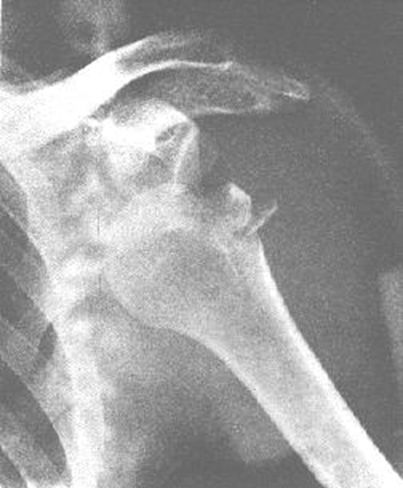 39种常见骨科疾病的X线表现，看你认识几种？