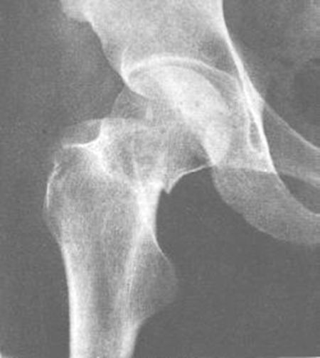 39种常见骨科疾病的X线表现，看你认识几种？