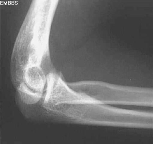 39种常见骨科疾病的X线表现，看你认识几种？