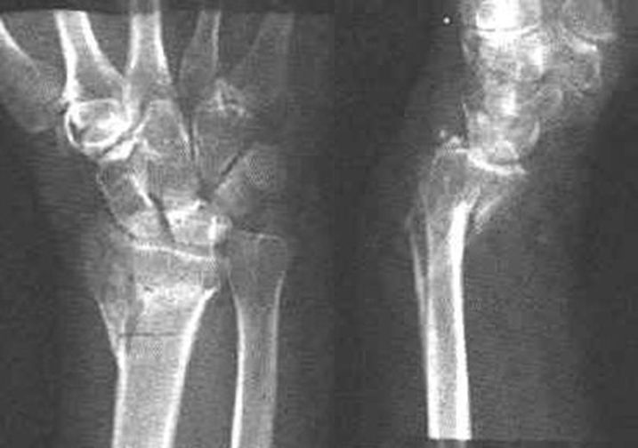 39种常见骨科疾病的X线表现，看你认识几种？