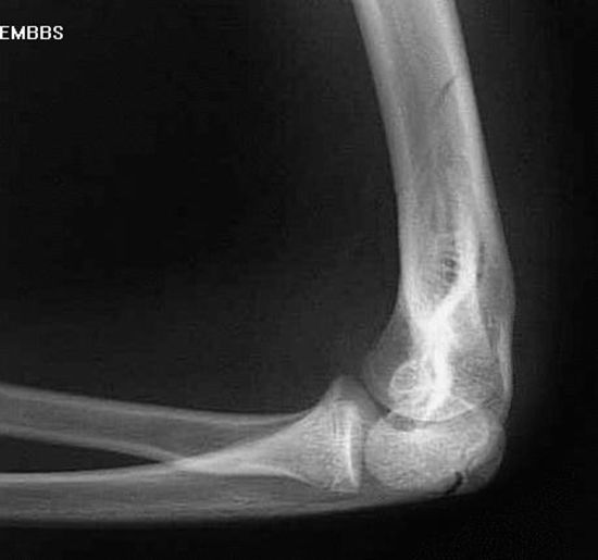 39种常见骨科疾病的X线表现，看你认识几种？