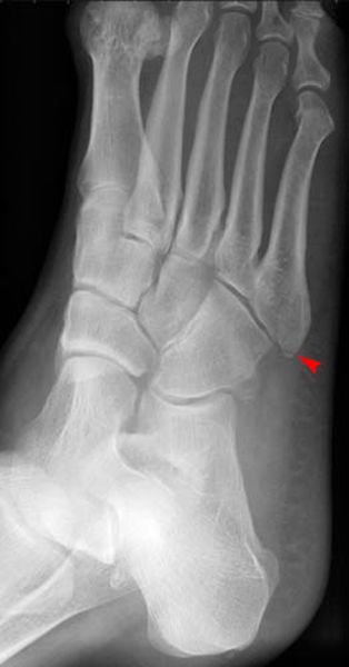 39种常见骨科疾病的X线表现，看你认识几种？