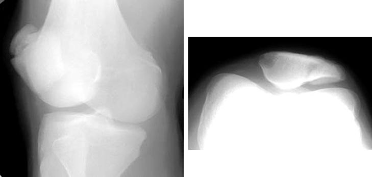 39种常见骨科疾病的X线表现，看你认识几种？