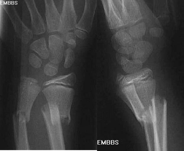 疼痛科怎么理疗疼痛科医生、康复理疗科医生、针刀针灸医生应掌握的常见骨科疾病X光片_https://www.jmylbn.com_新闻资讯_第17张
