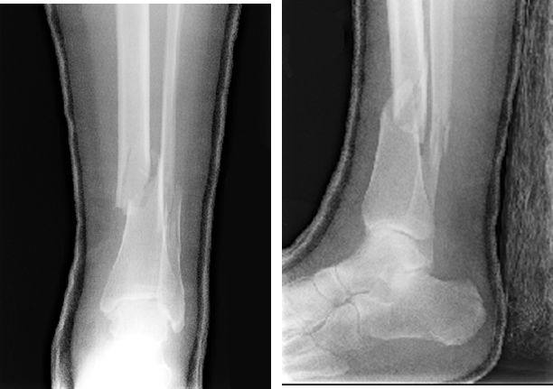39种常见骨科疾病的X线表现，看你认识几种？