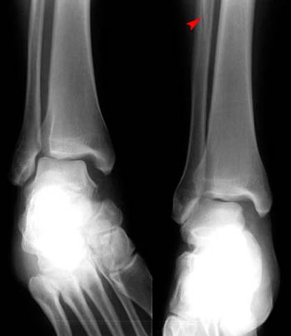 疼痛科怎么理疗疼痛科医生、康复理疗科医生、针刀针灸医生应掌握的常见骨科疾病X光片_https://www.jmylbn.com_新闻资讯_第37张