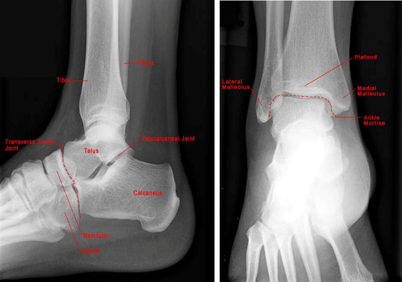 39种常见骨科疾病的X线表现，看你认识几种？