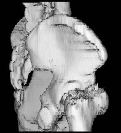 疼痛科怎么理疗疼痛科医生、康复理疗科医生、针刀针灸医生应掌握的常见骨科疾病X光片_https://www.jmylbn.com_新闻资讯_第51张