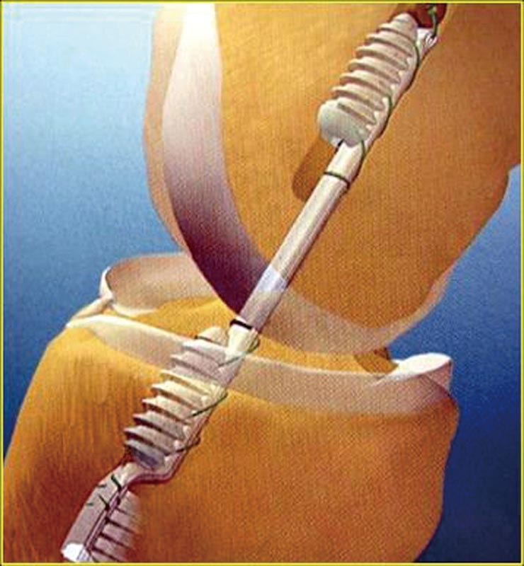 3分钟速读 | 前交叉韧带重建的5大要点