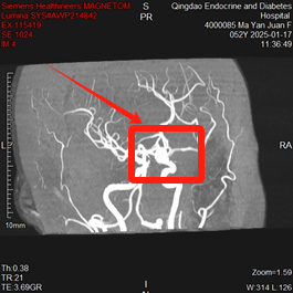 联磁共振是什么【内分泌糖尿病医院】AI查体联合磁共振“抓出”颅内动脉瘤_https://www.jmylbn.com_新闻资讯_第2张