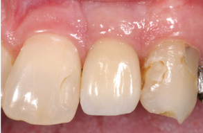 怎么选洁牙器械假牙又不会蛀牙，洗个牙怎么那么贵_https://www.jmylbn.com_新闻资讯_第6张