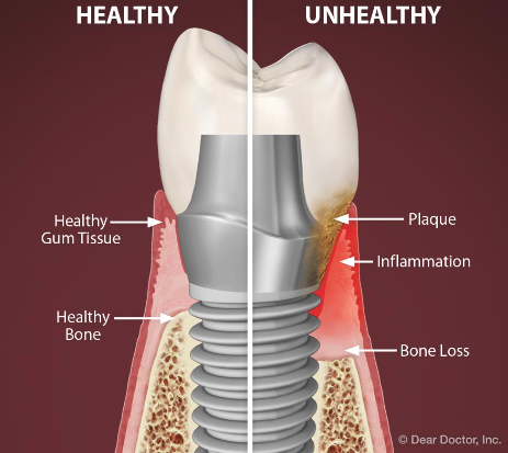 怎么选洁牙器械假牙又不会蛀牙，洗个牙怎么那么贵_https://www.jmylbn.com_新闻资讯_第12张