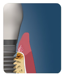 怎么选洁牙器械假牙又不会蛀牙，洗个牙怎么那么贵_https://www.jmylbn.com_新闻资讯_第4张