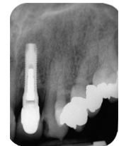 怎么选洁牙器械假牙又不会蛀牙，洗个牙怎么那么贵_https://www.jmylbn.com_新闻资讯_第7张