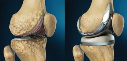 怎么选洁牙器械假牙又不会蛀牙，洗个牙怎么那么贵_https://www.jmylbn.com_新闻资讯_第10张