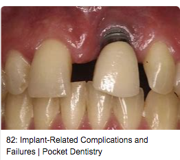 怎么选洁牙器械假牙又不会蛀牙，洗个牙怎么那么贵_https://www.jmylbn.com_新闻资讯_第5张