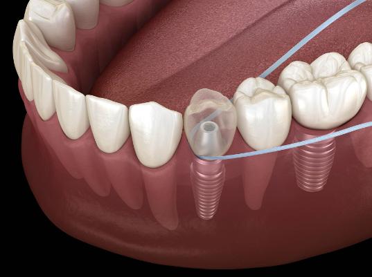 怎么选洁牙器械假牙又不会蛀牙，洗个牙怎么那么贵_https://www.jmylbn.com_新闻资讯_第15张