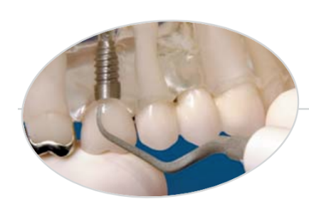 怎么选洁牙器械假牙又不会蛀牙，洗个牙怎么那么贵_https://www.jmylbn.com_新闻资讯_第14张