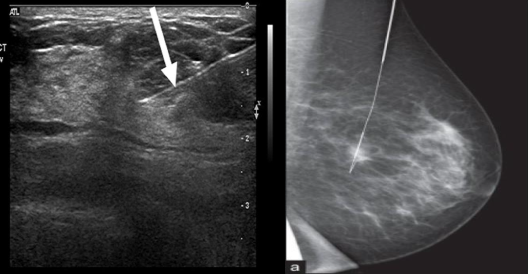 为什么要定位针 乳腺方医生专栏 ｜ 手术前的病灶定位，要在我的胸上插根针？！超声引导下乳腺金属定位导丝置入术究竟是怎么做的？_https://www.jmylbn.com_新闻资讯_第3张