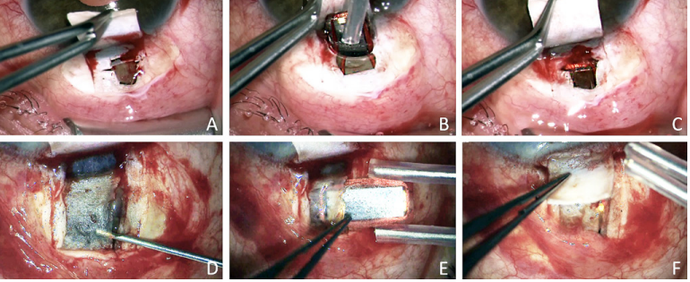 眼突计怎么用【惟视资讯】眼睛里植入一枚小芯片，术后不用跑医院，患者在家就能实现“测眼压自由”！准确性堪比“金标准”压平眼压计！_https://www.jmylbn.com_新闻资讯_第3张